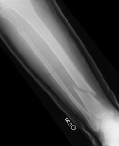 health%20medical%20x%20ray%20of%20broken%20fracture%20leg.jpg